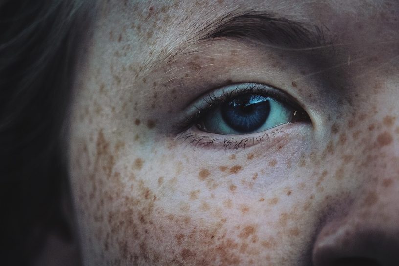 Lighten and Reduce Freckles